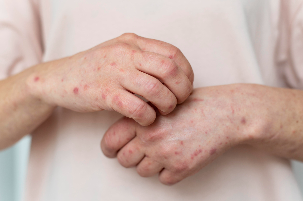 Virus mpox : le Kazakhstan annonce des mesures